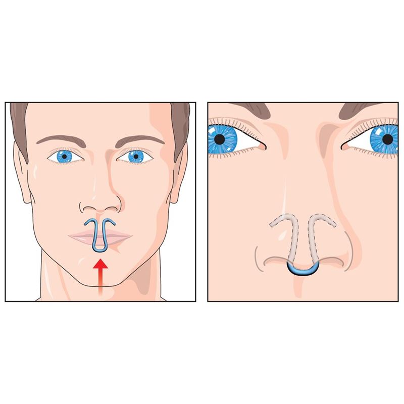 CLIPAIR Nasendilatator für Schlaf und Sport 3 Stk
